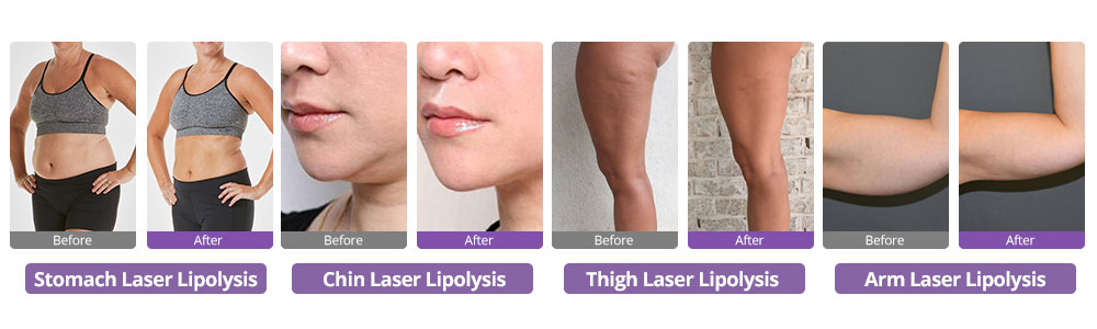 lipo laser machine treatment effect